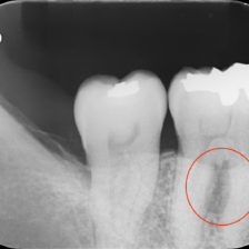 江東区大島・東大島の歯医者、あおぞら歯科で歯根部病変についての解説